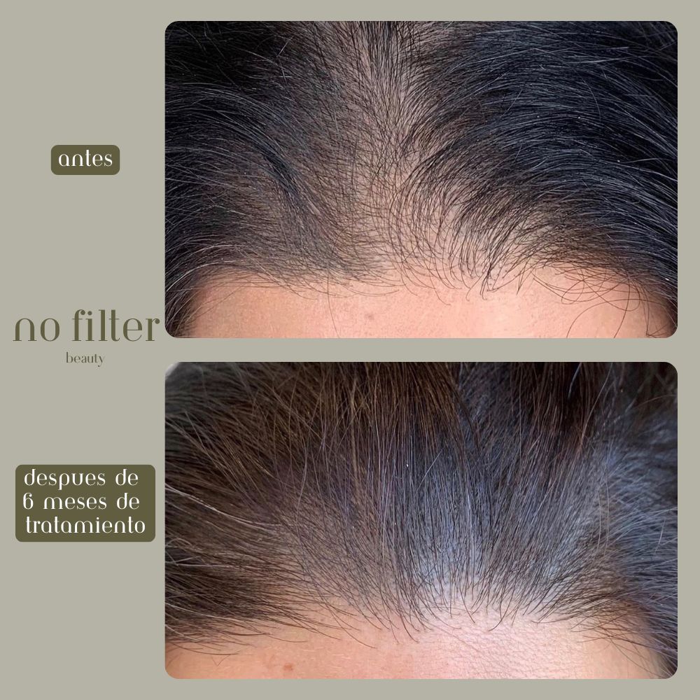 Kit Microinfusión Capilar Hair Growth